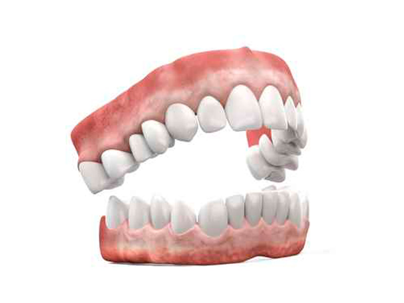 Prótesis dental completa