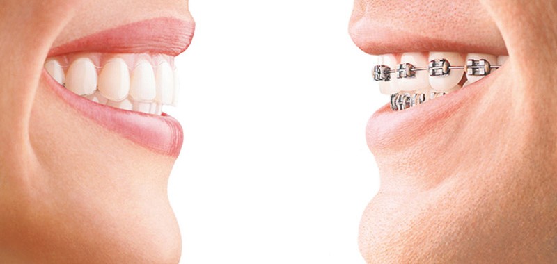 ortodoncia convencional i invisible