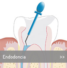 es-tratamiento-Endodoncial