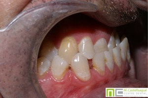 Protrusió ortodòncia granollers centre dental castellsagué