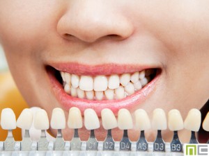 Personalized tooth whitening 0