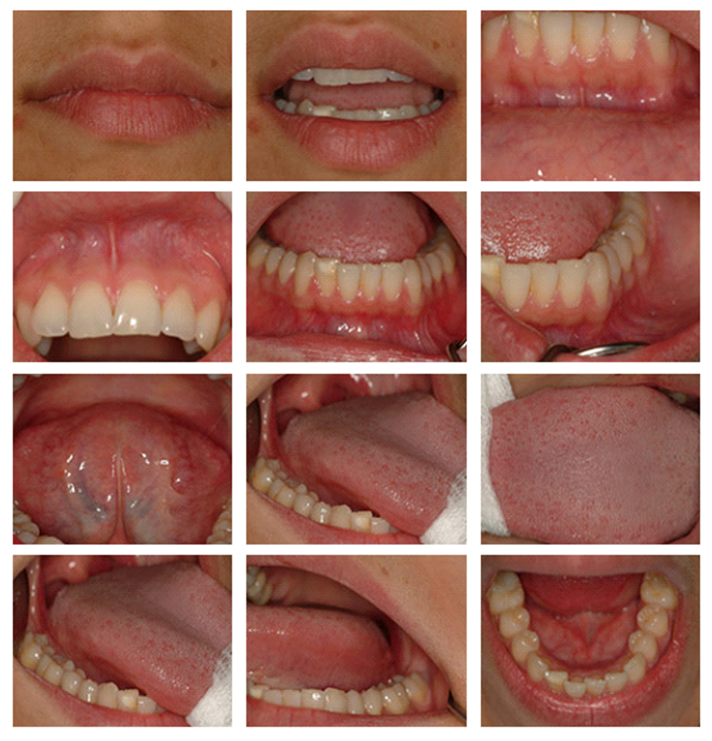 exploración cáncer oral consejo dentistas