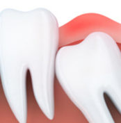 Toothache and inflammation in wisdom tooth. 3d illustration