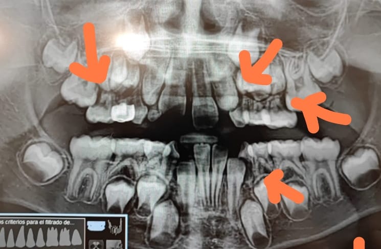 The importance of taking X-rays at 6 years 4